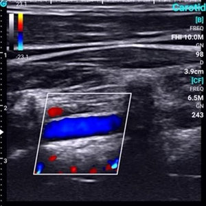 
                  
                    Supper Small Chison SonoEye  P1 Linear Array for android Color Doppler Vascular
                  
                